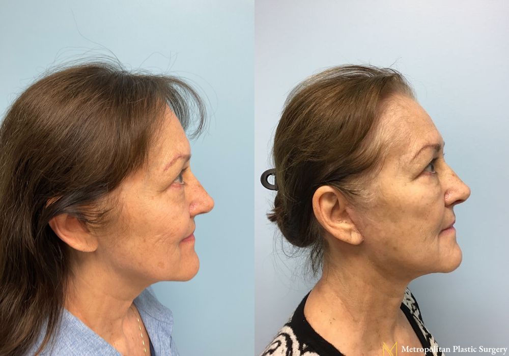 Facelift & Neck Lift - Case 129