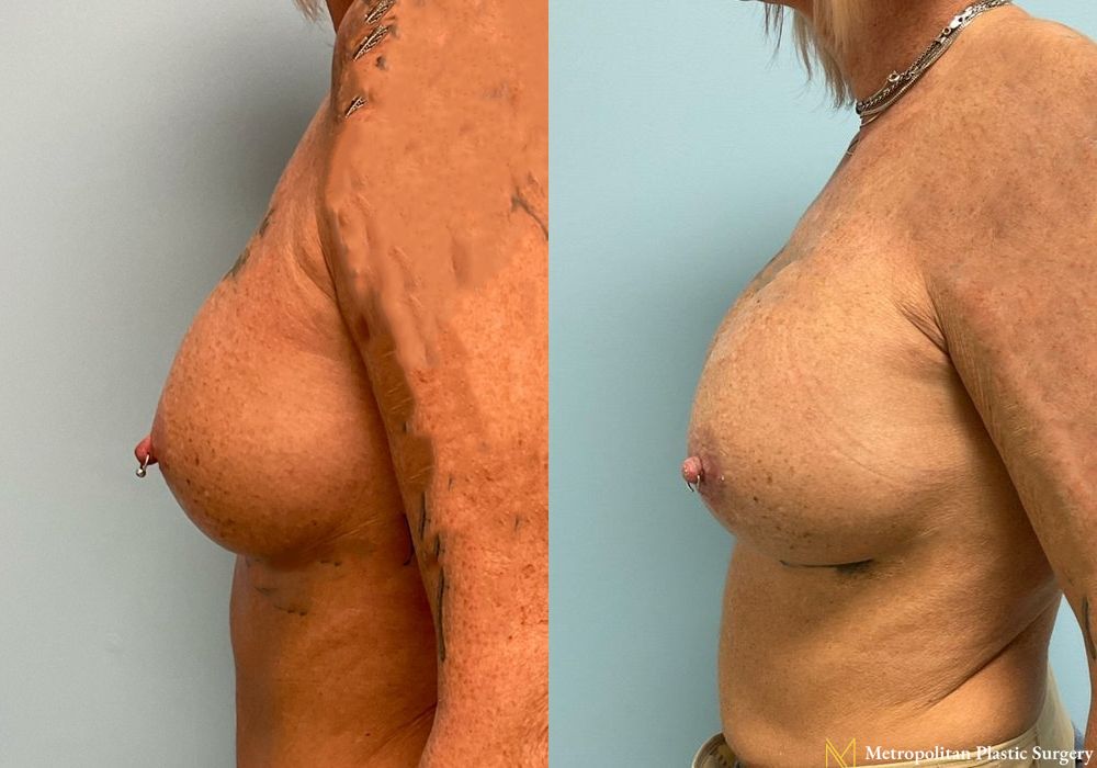 Breast Augmentation - Thumbnail 2