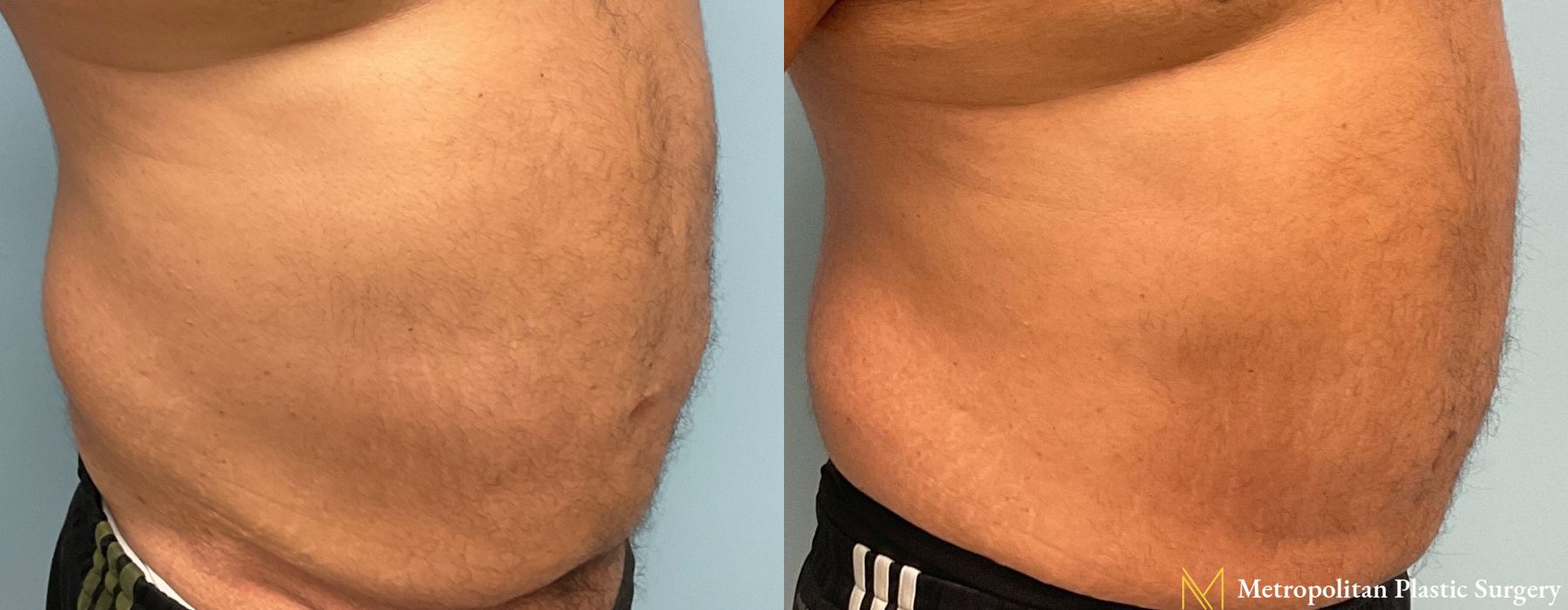 Liposuction - Thumbnail 3