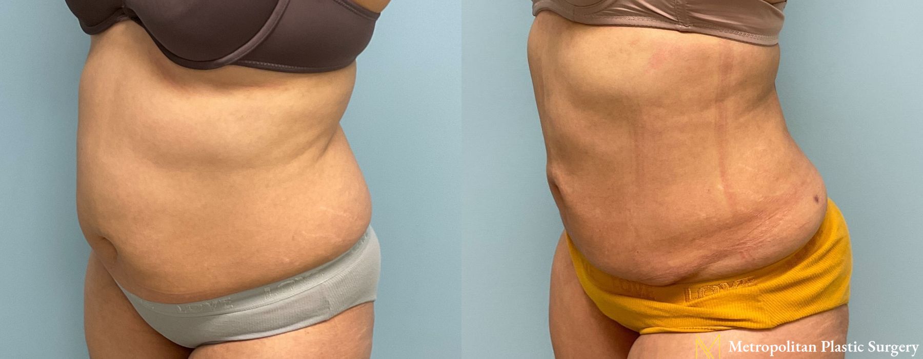 Abdominoplasty - Thumbnail 5