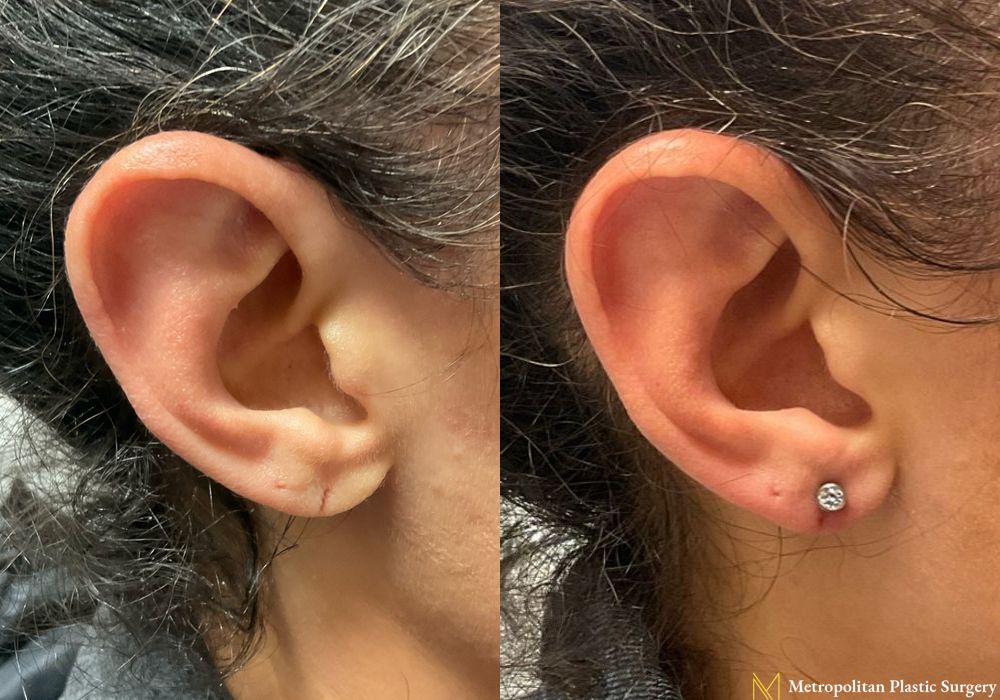 Earlobe Surgery - Case 126