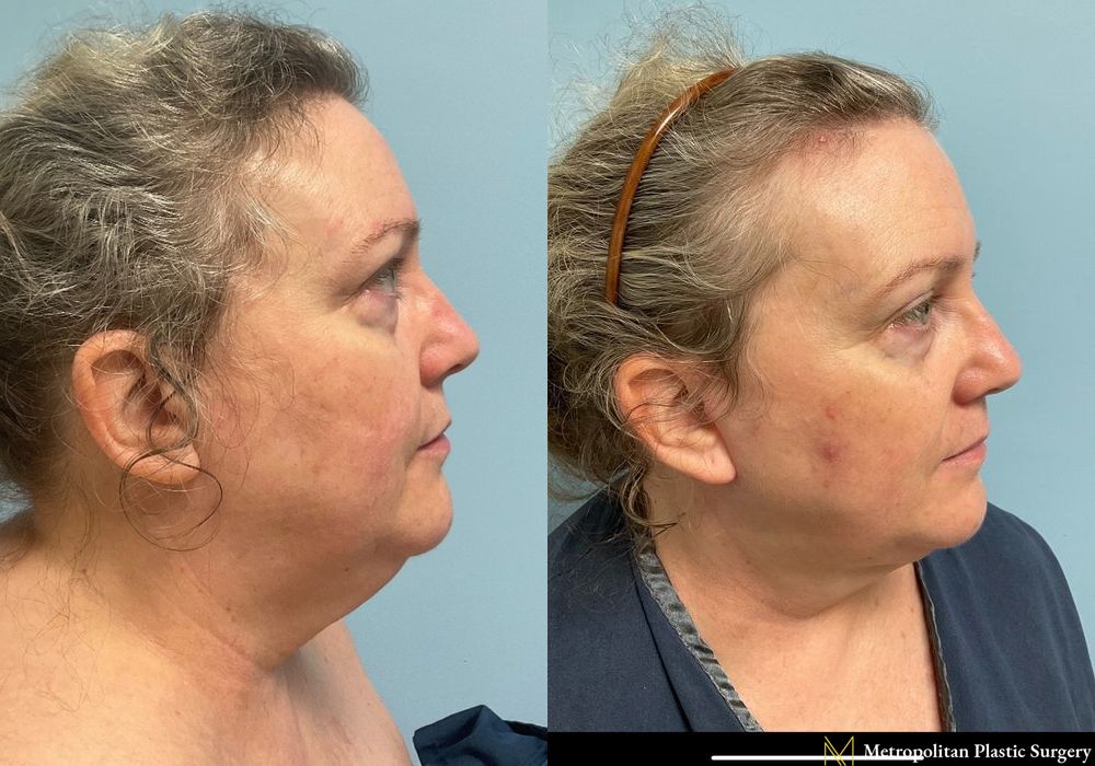 Facelift & Neck Lift - Thumbnail 2