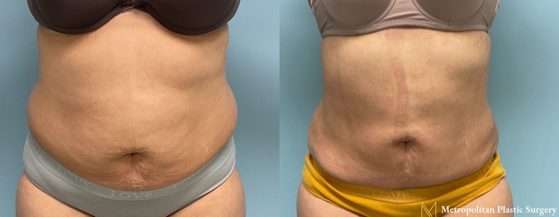 Abdominoplasty - Case 164