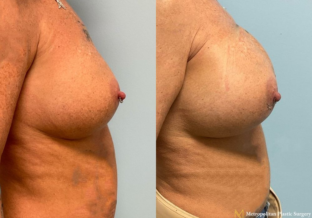 Breast Augmentation - Thumbnail 5