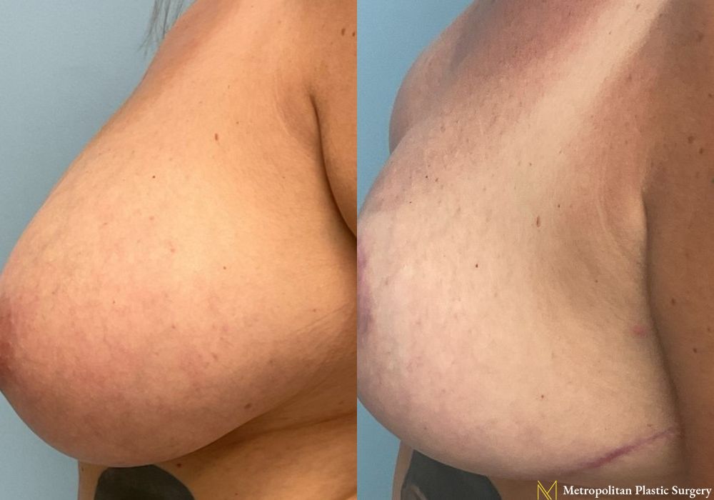 Breast Reduction - Thumbnail 4