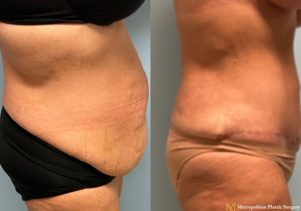 Abdominoplasty - Thumbnail 2