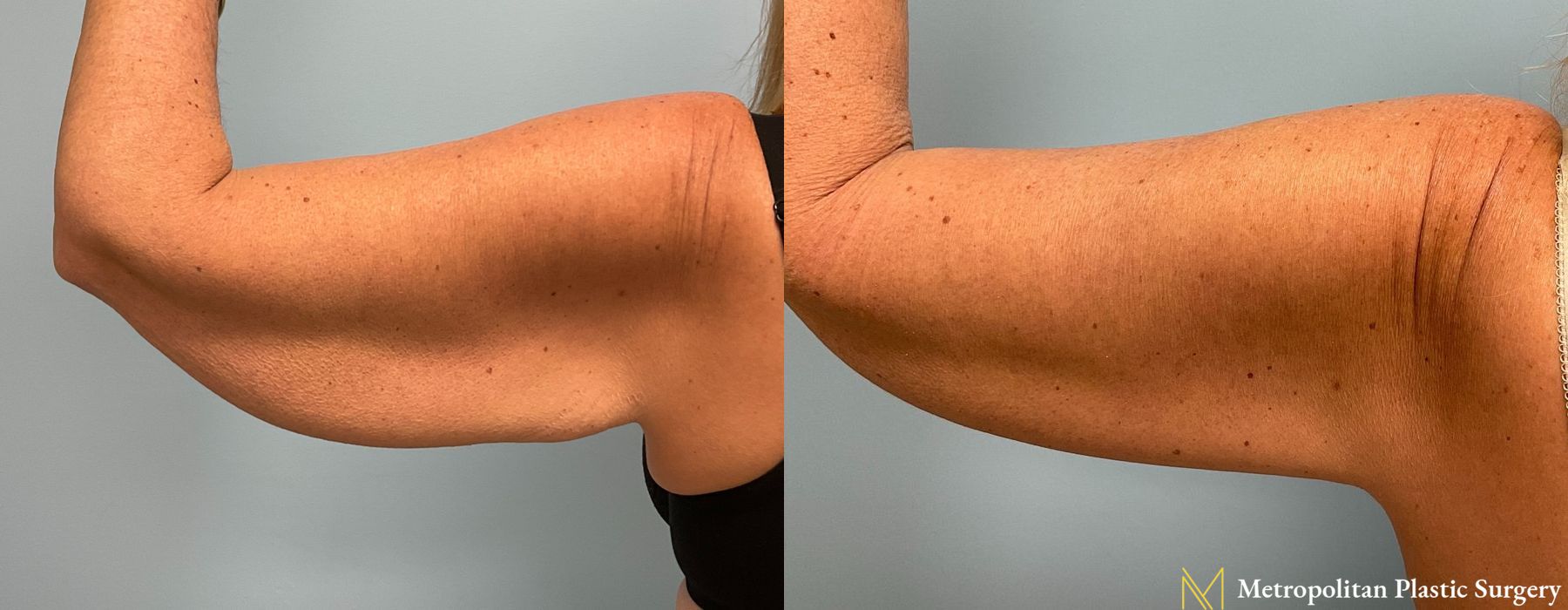 Brachioplasty - Case 82