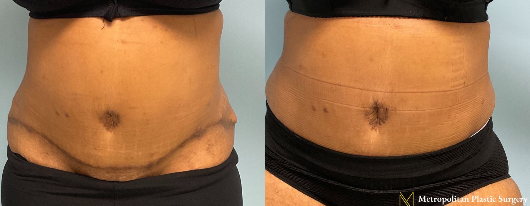 Liposuction - Case 213