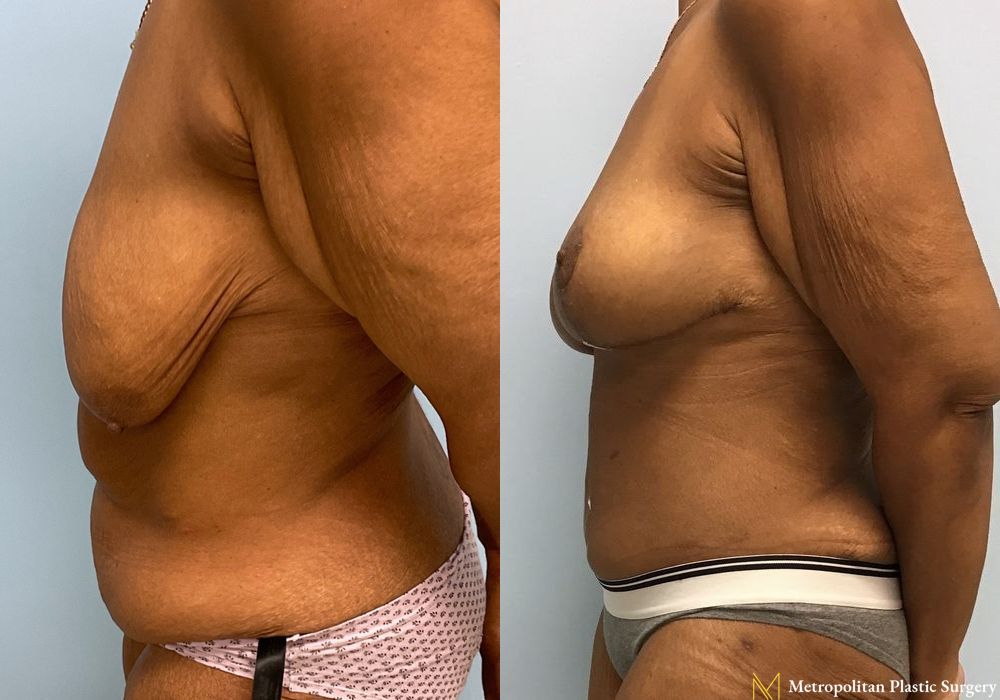 Abdominoplasty - Thumbnail 2