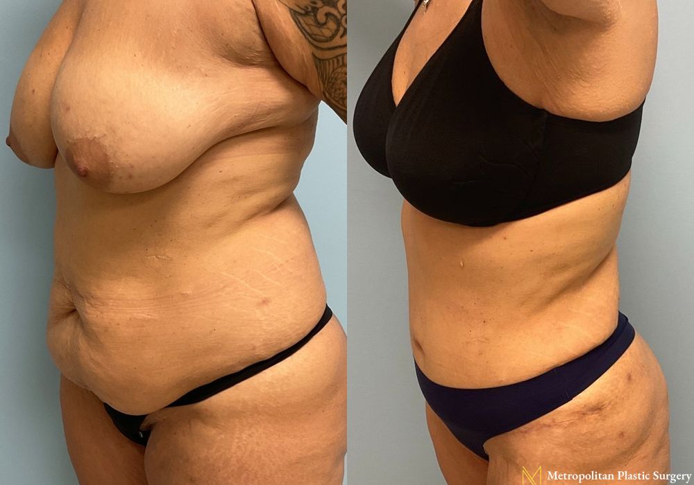 Abdominoplasty - Thumbnail 5