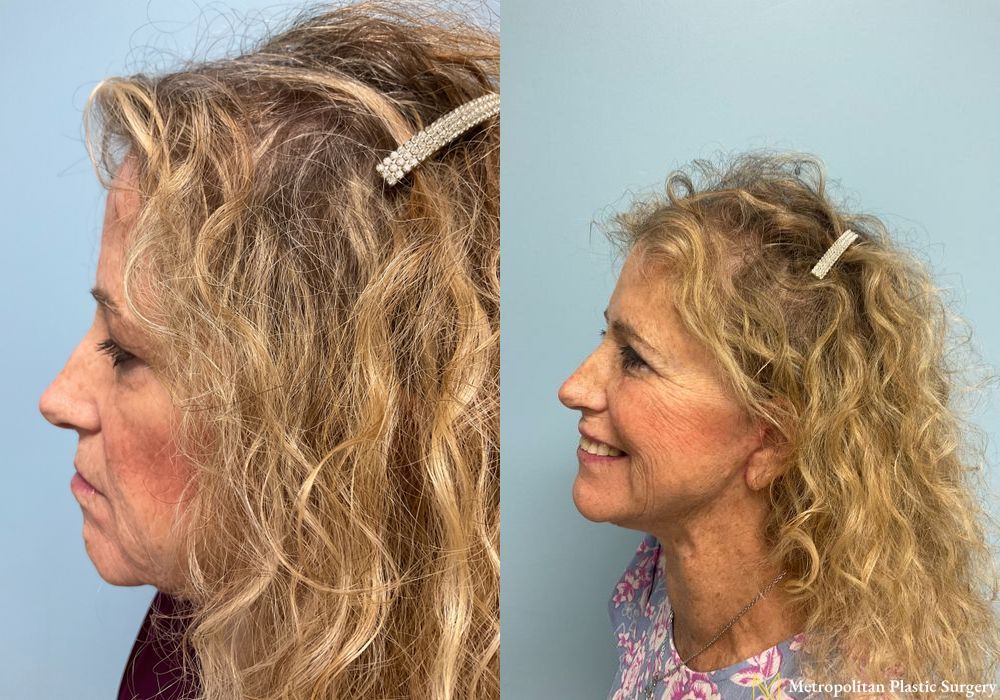 Facelift & Neck Lift - Thumbnail 2