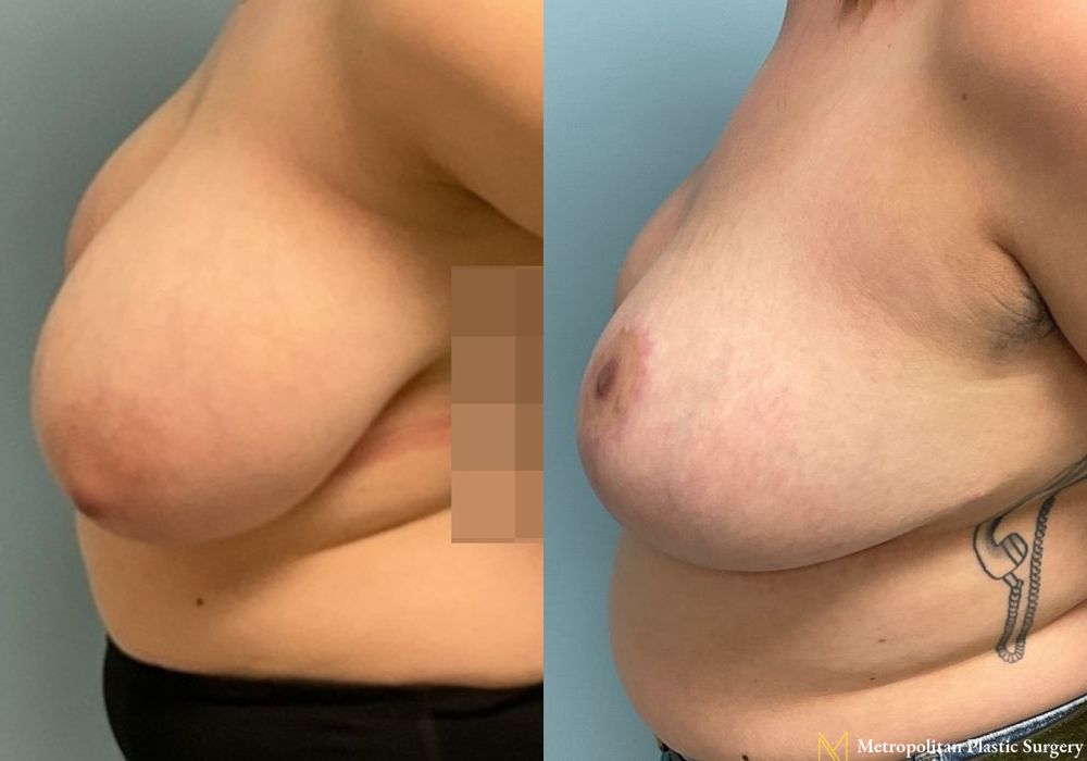 Breast Reduction - Thumbnail 5
