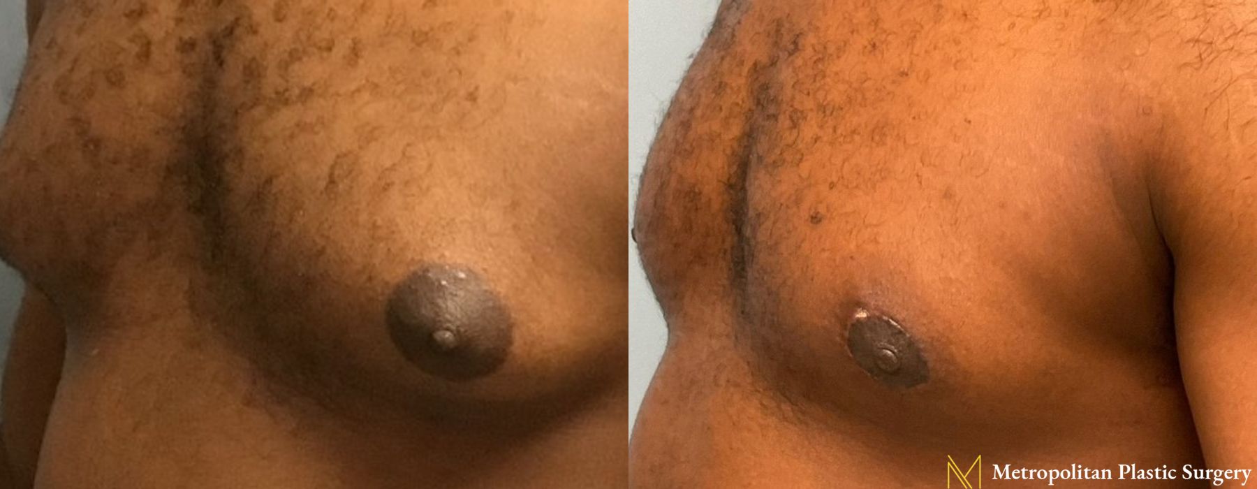 Gynecomastia - Thumbnail 3