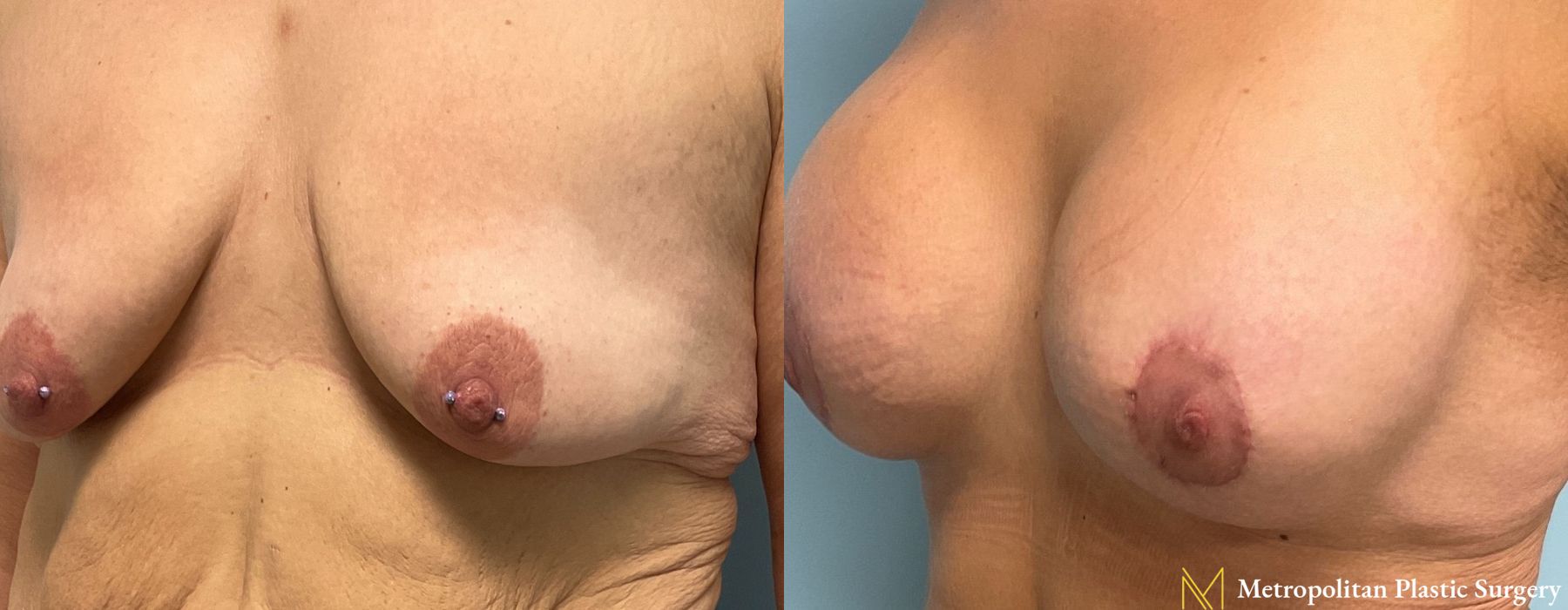 Breast Lift with Implants - Thumbnail 3