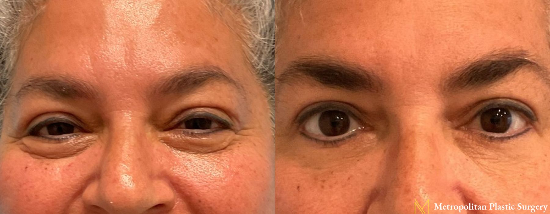 Blepharoplasty - Case 118