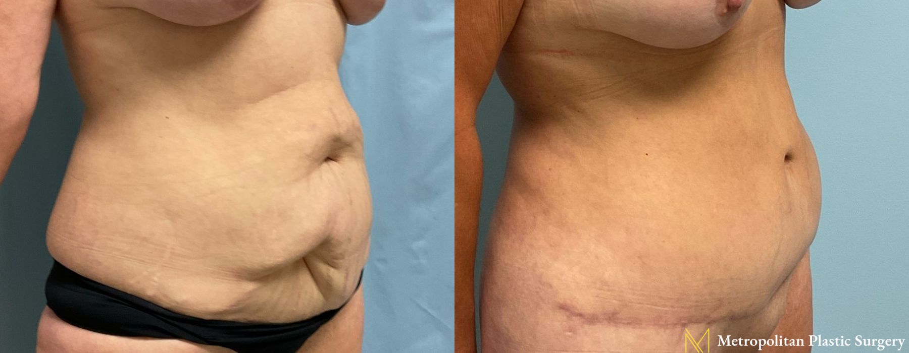 Abdominoplasty - Thumbnail 3