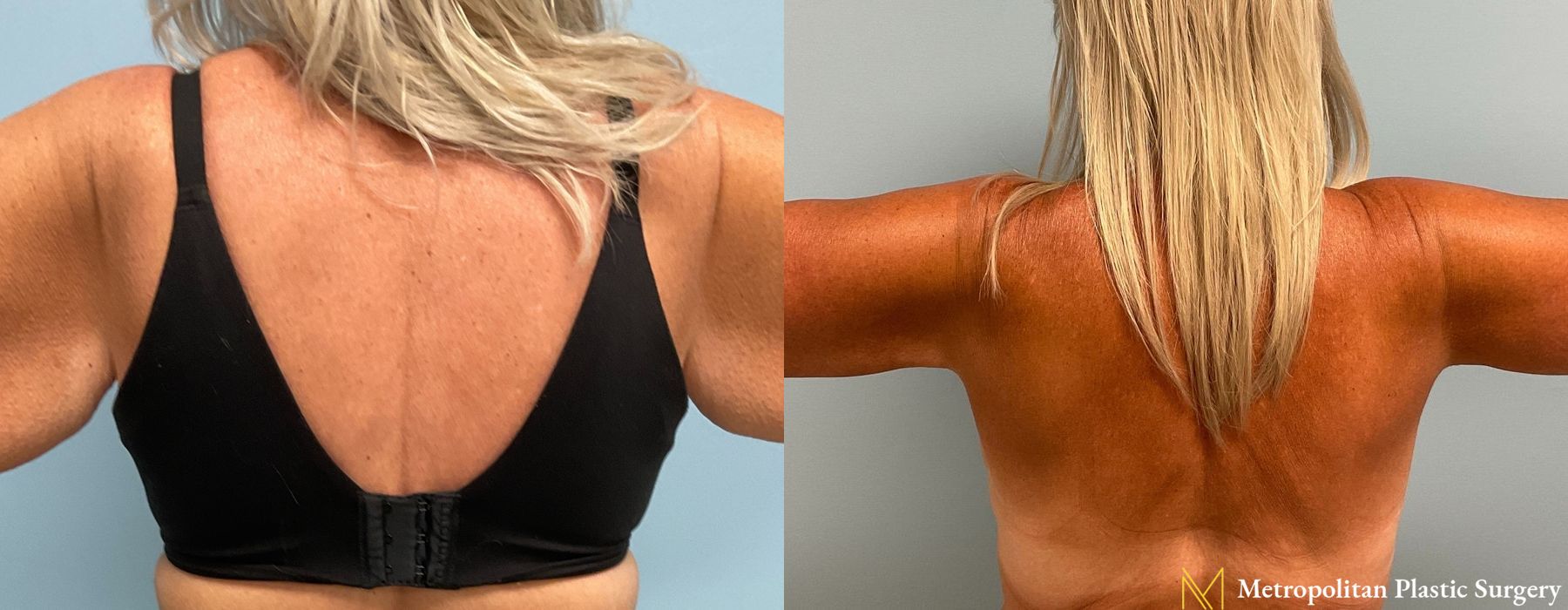 Brachioplasty - Case 78