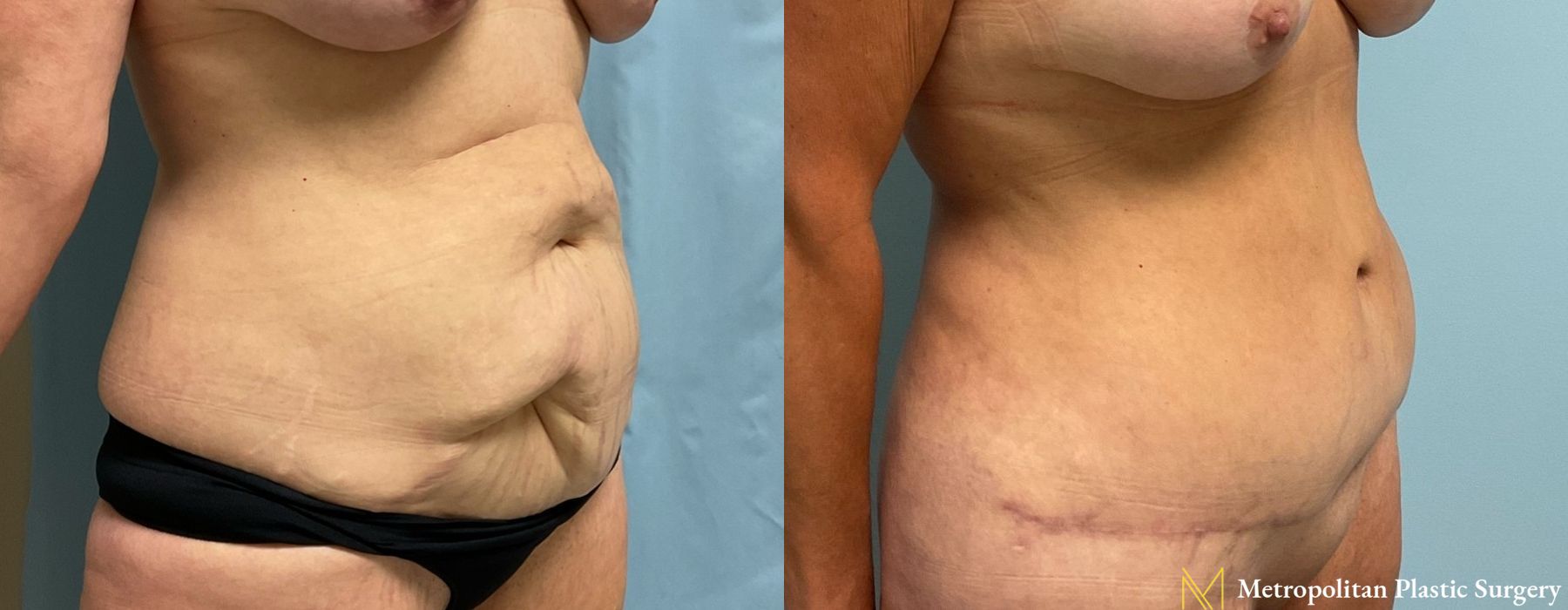 Abdominoplasty - Thumbnail 5