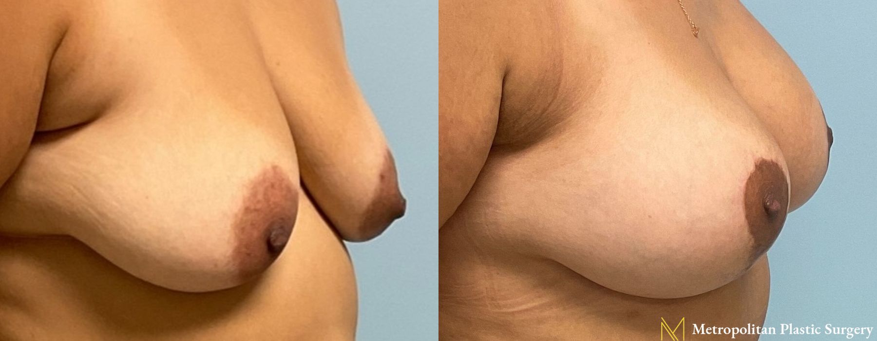 Breast Augmentation - Thumbnail 3
