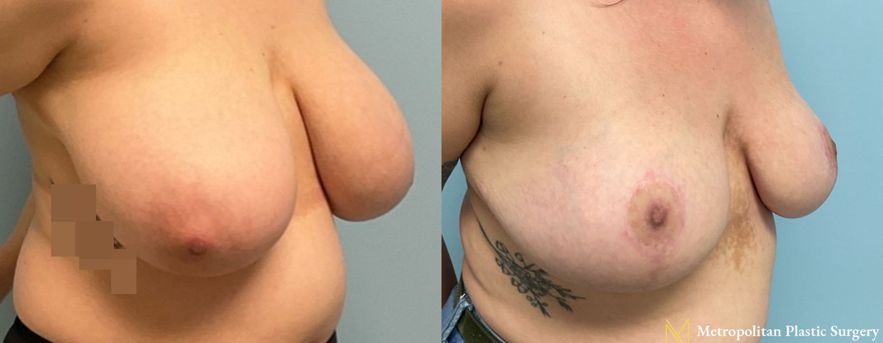 Breast Reduction - Thumbnail 2