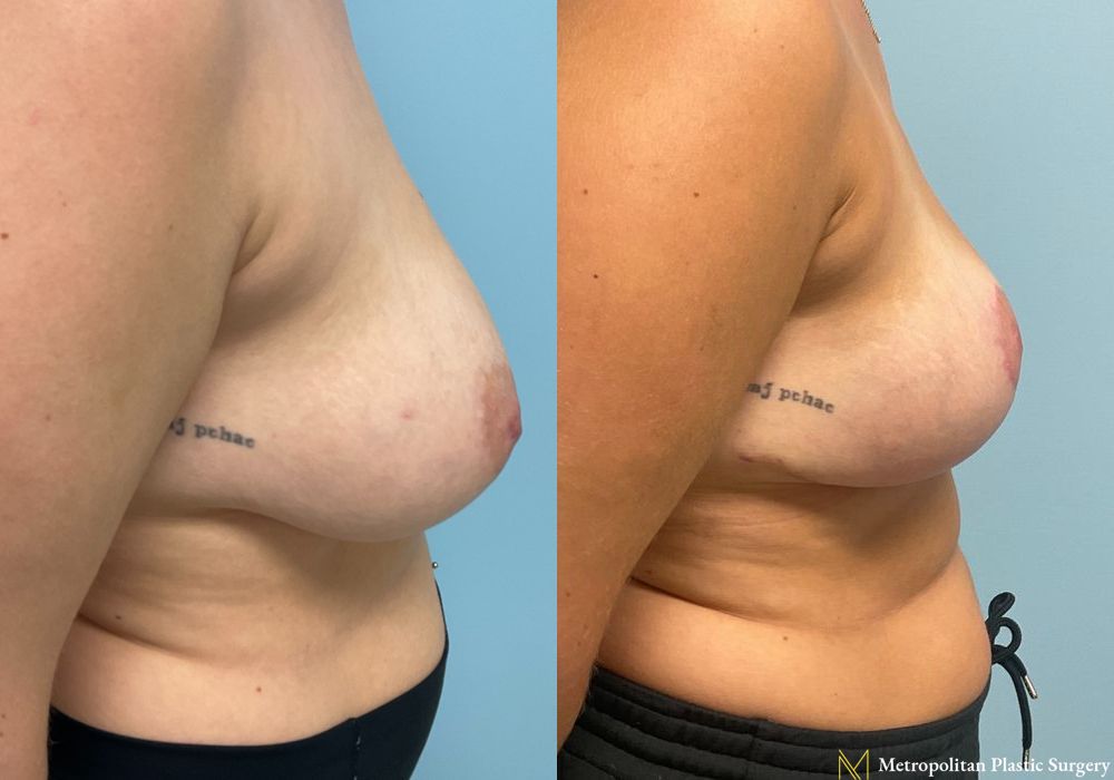 Breast Reduction - Thumbnail 3