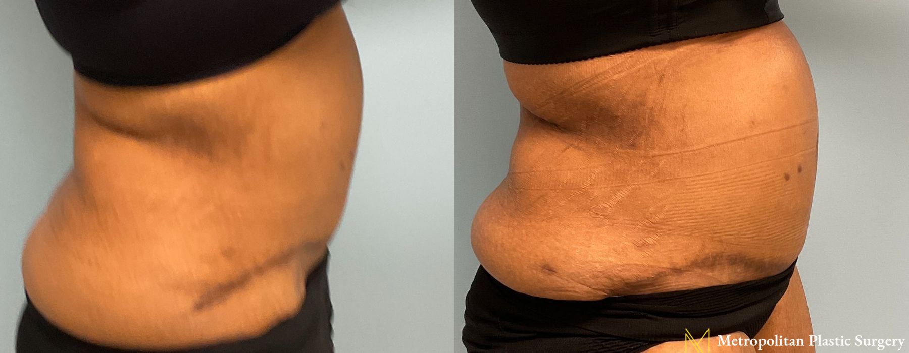 Liposuction - Thumbnail 2