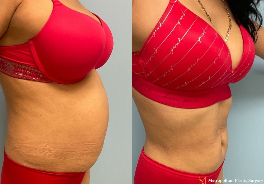 Liposuction - Thumbnail 3