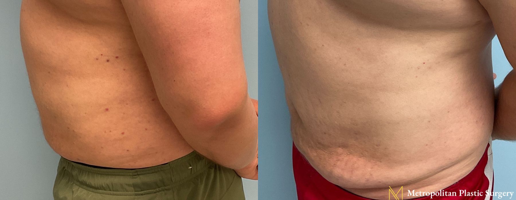 Liposuction - Thumbnail 4