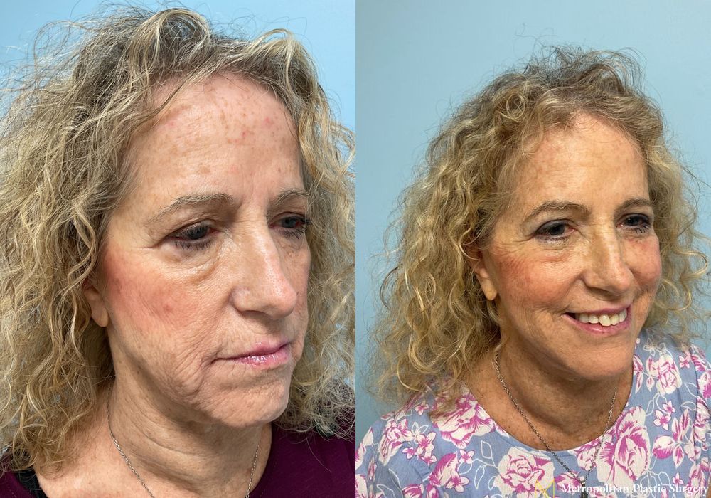 Facelift & Neck Lift - Thumbnail 5