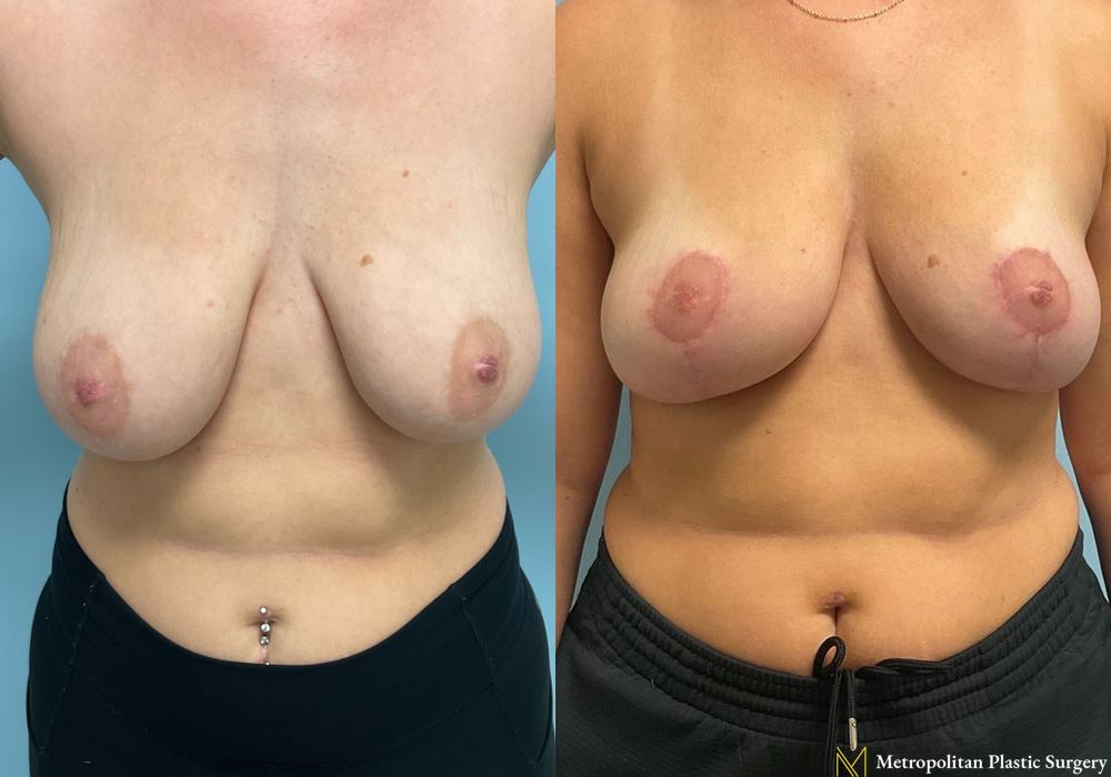 Breast Reduction - Thumbnail 5