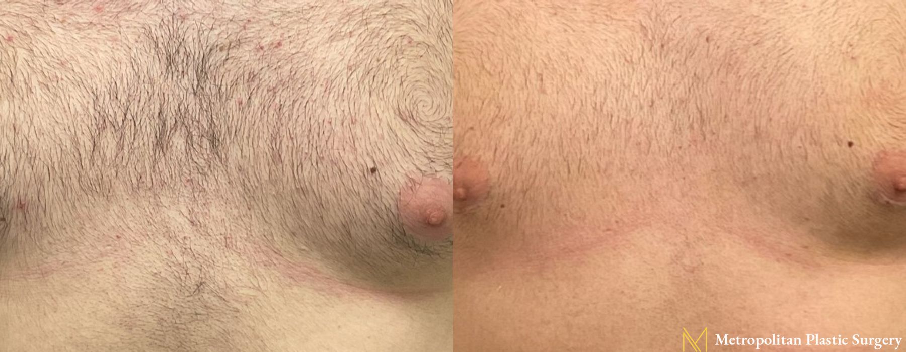 Gynecomastia - Case 115