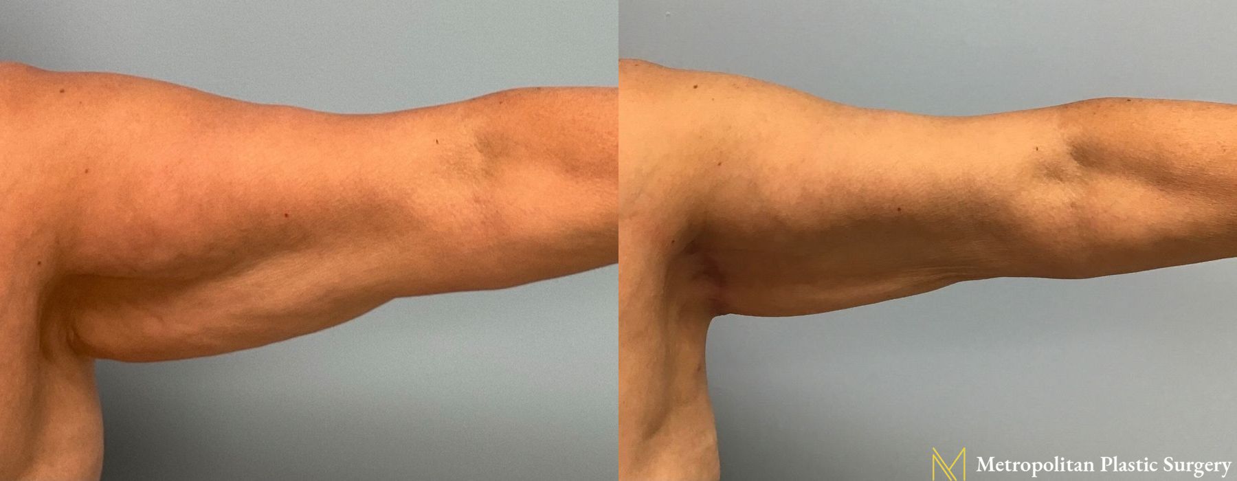 Brachioplasty - Case 84