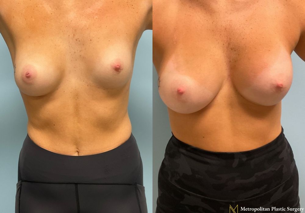 Breast Augmentation - Case 94