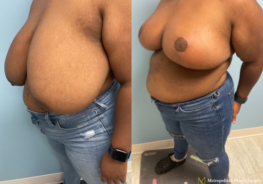 Breast Reduction - Thumbnail 4