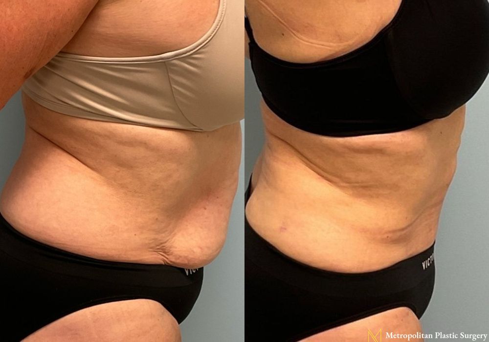 Abdominoplasty - Thumbnail 2