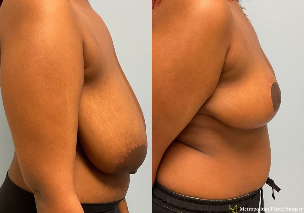 Breast Reduction - Case 104