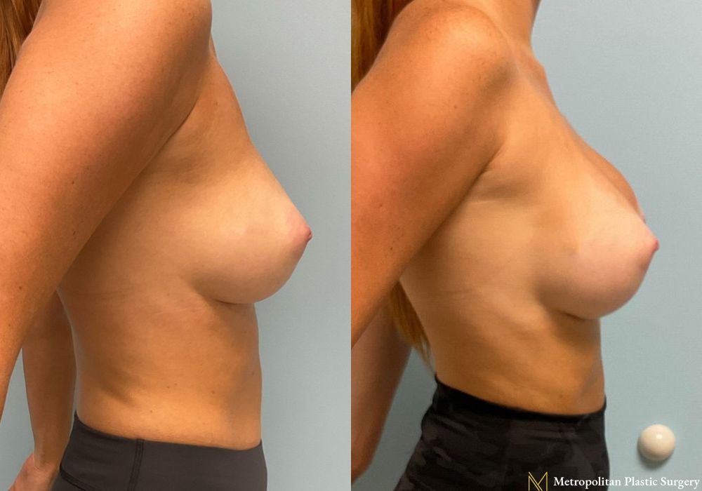 Breast Augmentation - Thumbnail 5