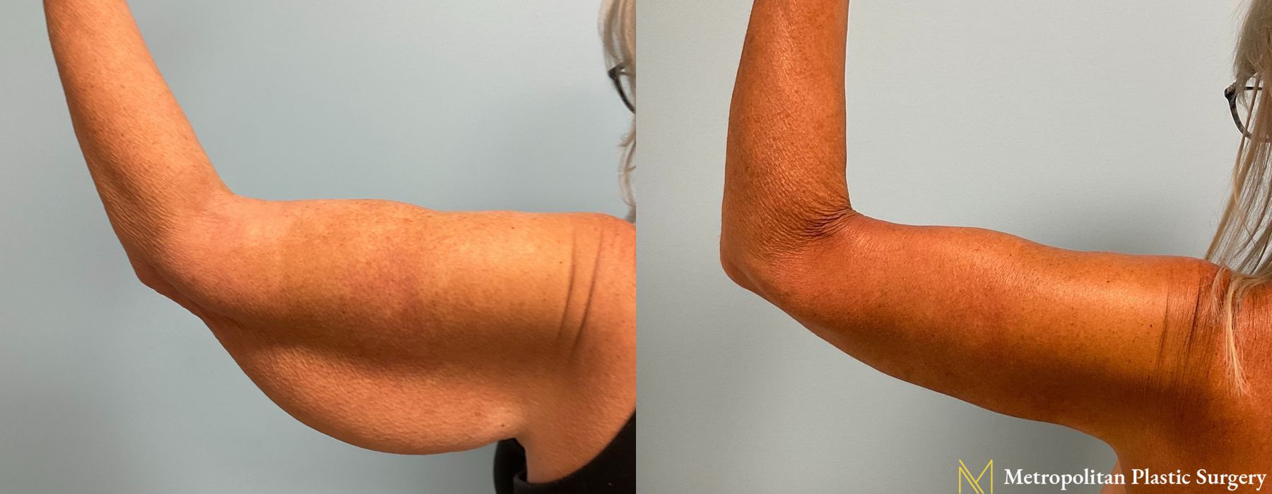 Brachioplasty - Thumbnail 3
