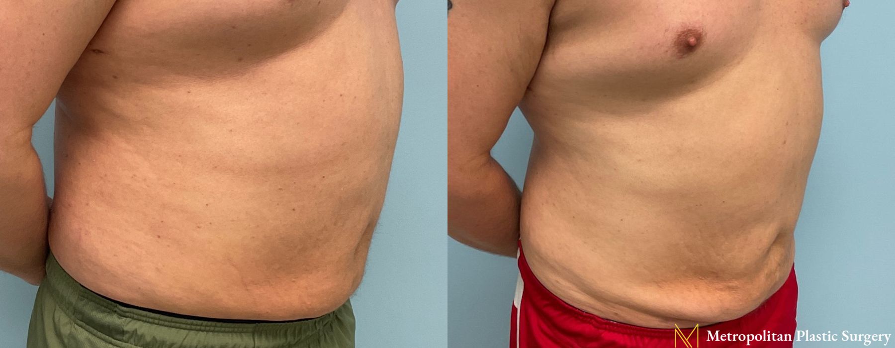 Liposuction - Thumbnail 3