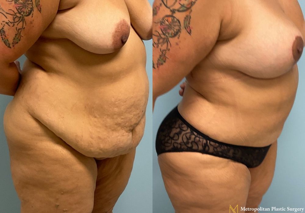 Abdominoplasty - Case 71