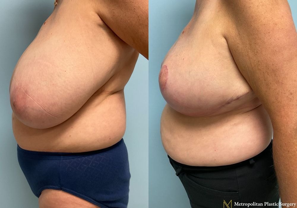 Breast Reduction - Thumbnail 4