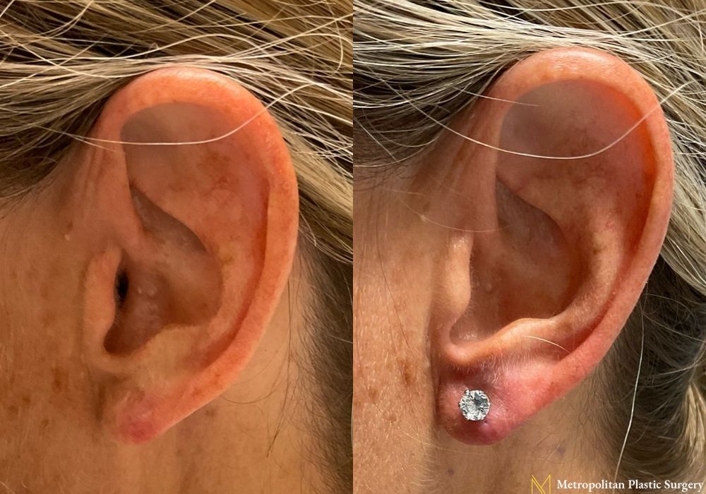 Earlobe Surgery - Thumbnail 2