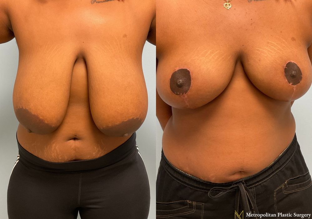 Breast Reduction - Thumbnail 3