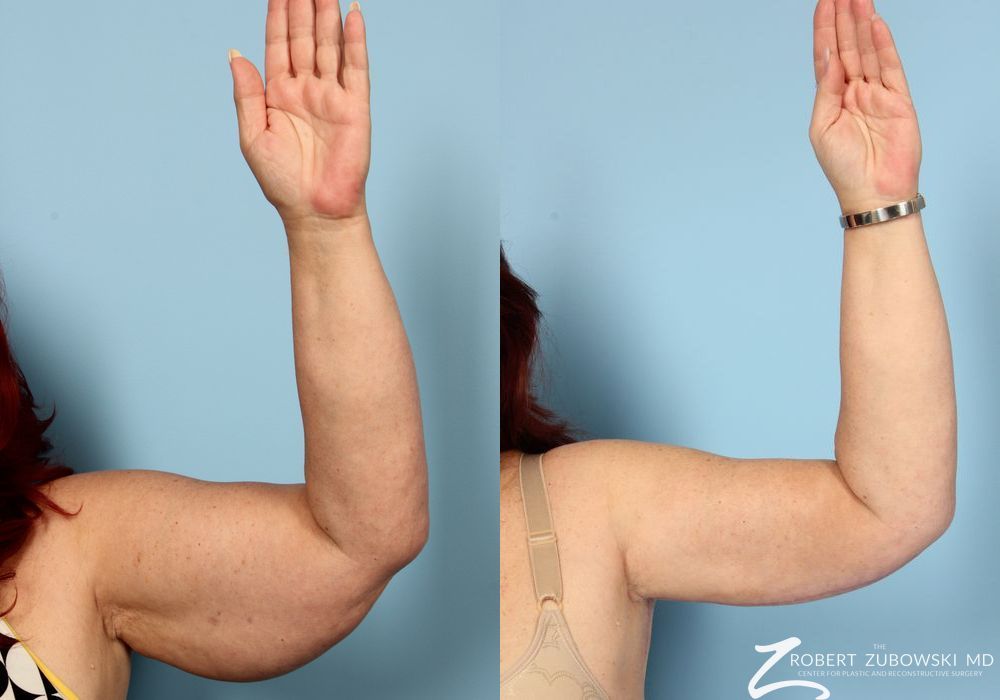 Arm Lift - Thumbnail 2