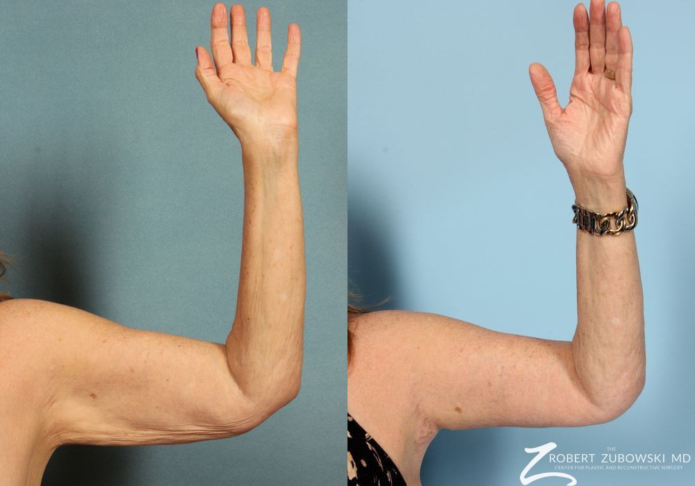 Arm Lift - Thumbnail 2