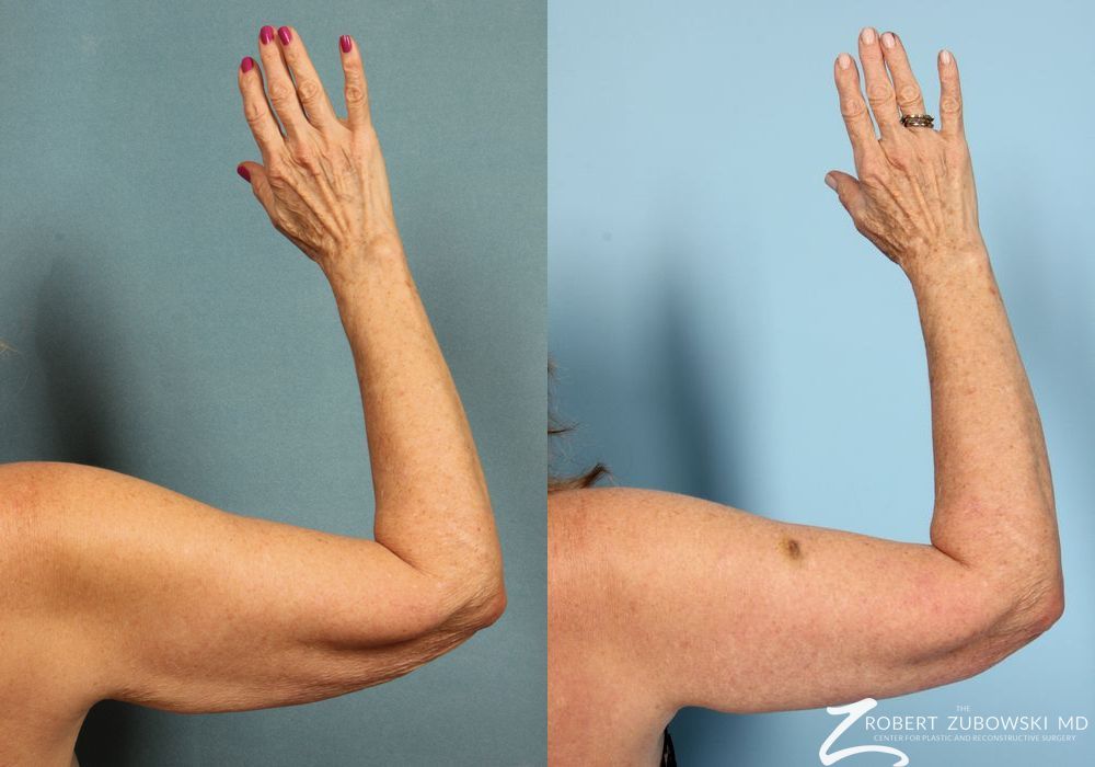 Arm Lift - Case 3500