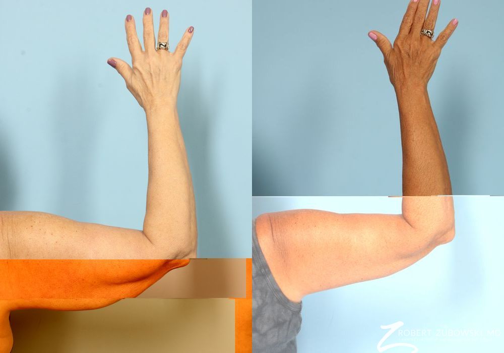 Arm Lift - Thumbnail 4