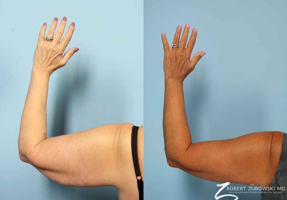 Arm Lift - Case 3503