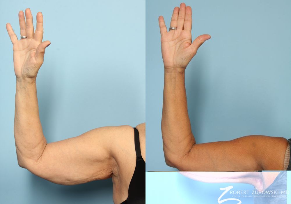 Arm Lift - Thumbnail 3