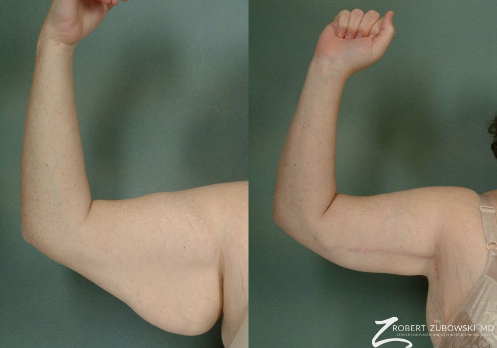 Arm Lift - Thumbnail 2